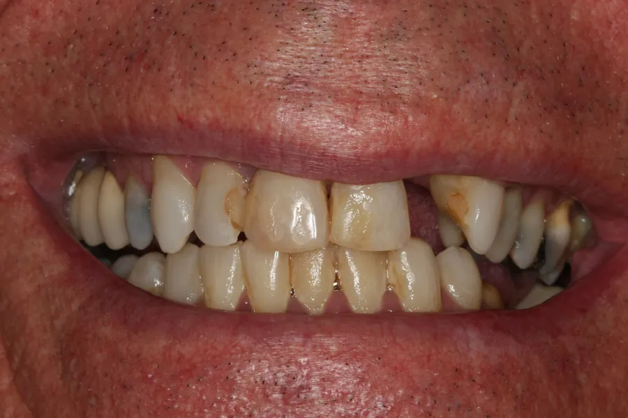 Before (close-up), Full-Smile Rebuild (20 Teeth): Dale