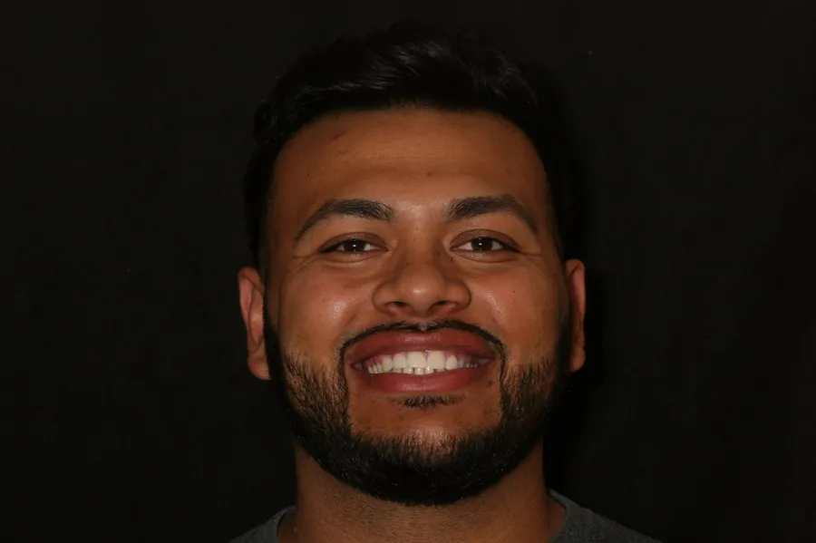 After, 4 Porcelain Veneers: David