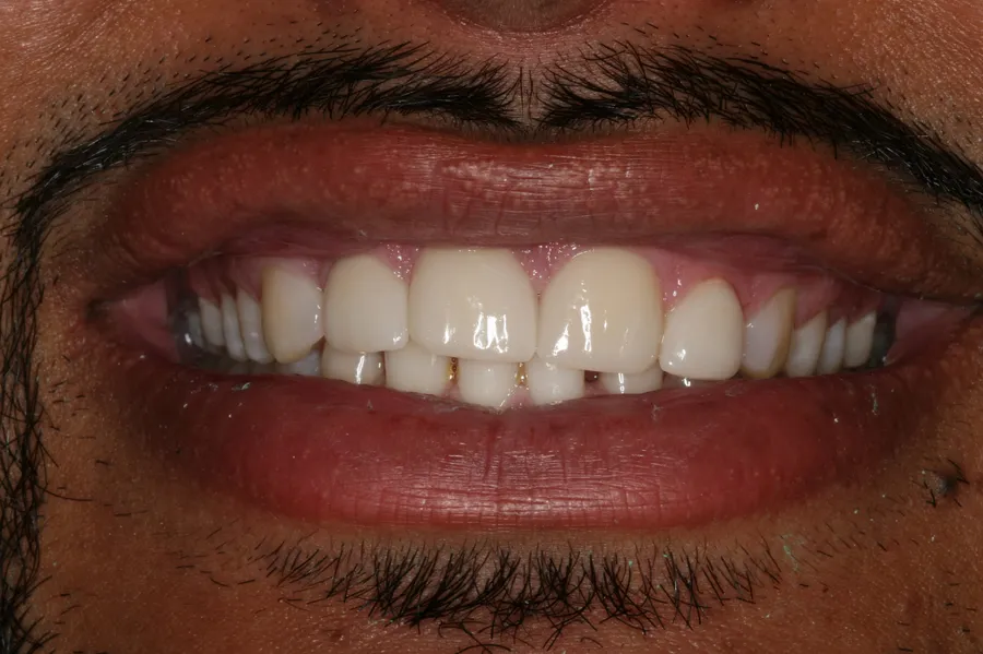 After (close-up), 4 Porcelain Veneers: David