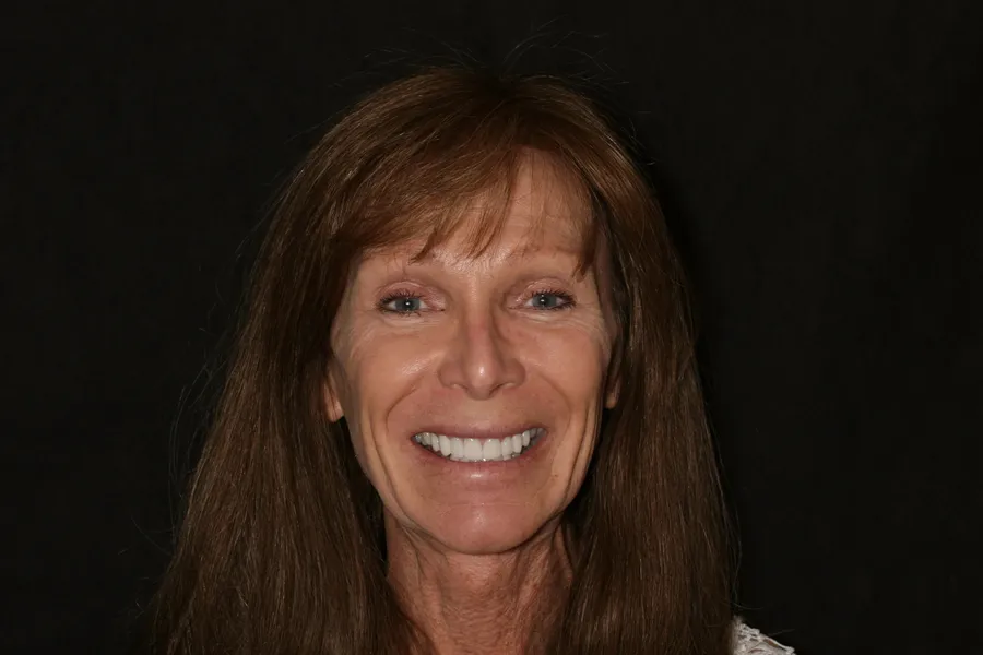 After, 14 Porcelain Veneers: Debbie