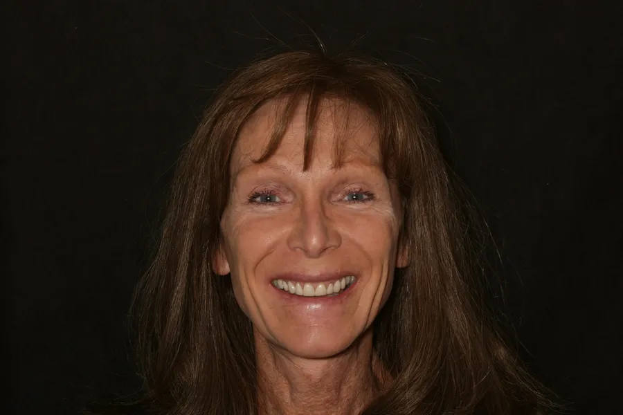 Before, 14 Porcelain Veneers: Debbie