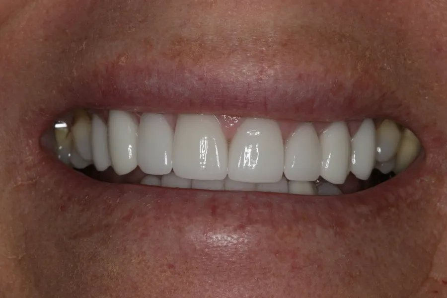 After (close-up), 14 Porcelain Veneers: Debbie