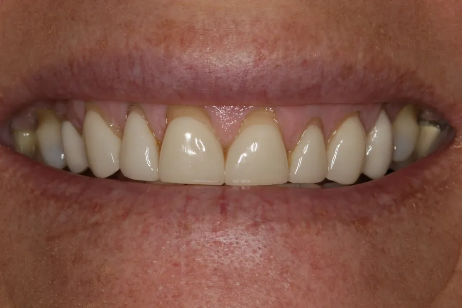 Before (close-up), 14 Porcelain Veneers: Debbie