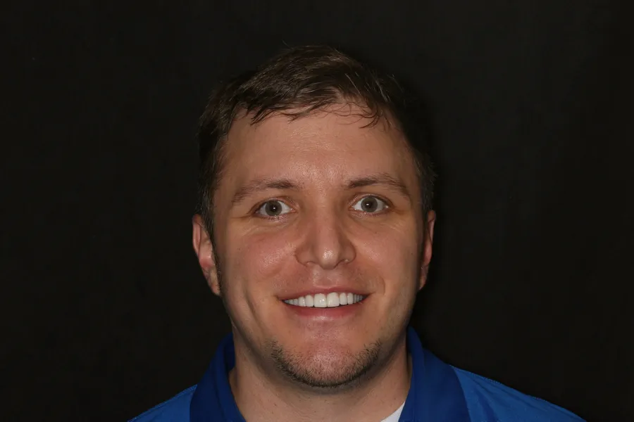 After, 4 Porcelain Veneers: Dennis