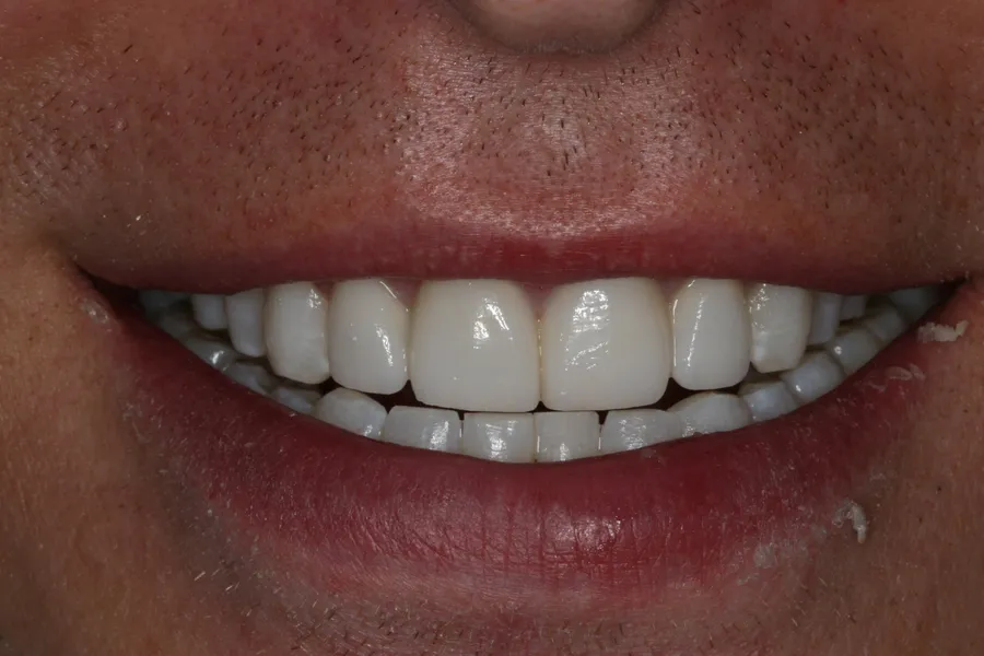 After (close-up), 4 Porcelain Veneers: Dennis