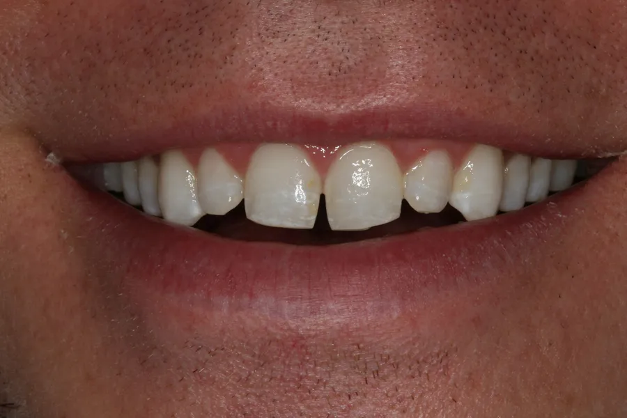 Before (close-up), 4 Porcelain Veneers: Dennis