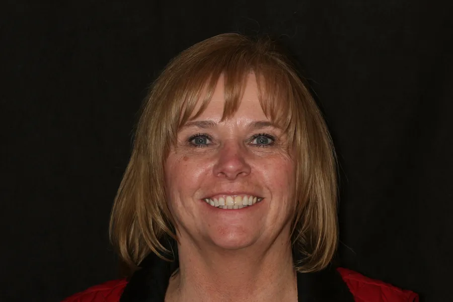 Before, 8 Porcelain Veneers: Diane