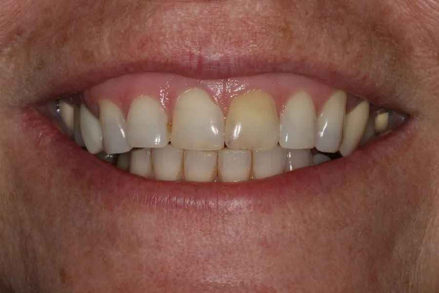 Before (close-up), 8 Porcelain Veneers: Diane