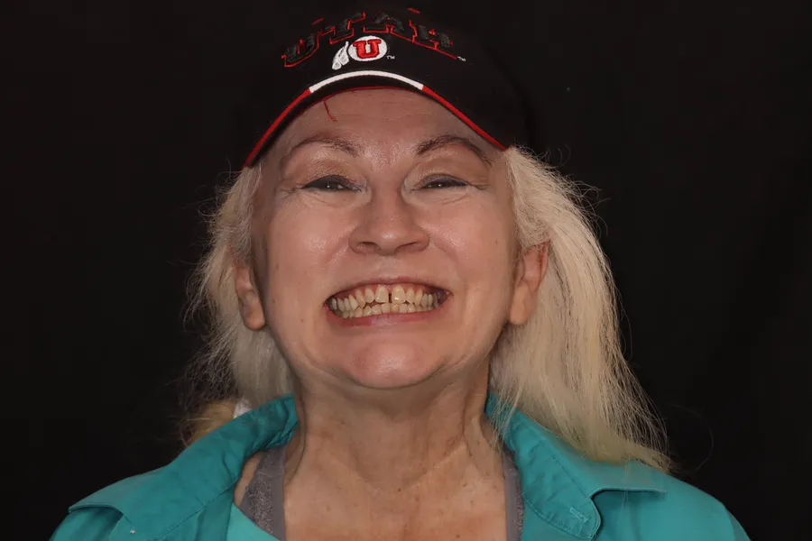 Before, 6 Porcelain Veneers: DJ