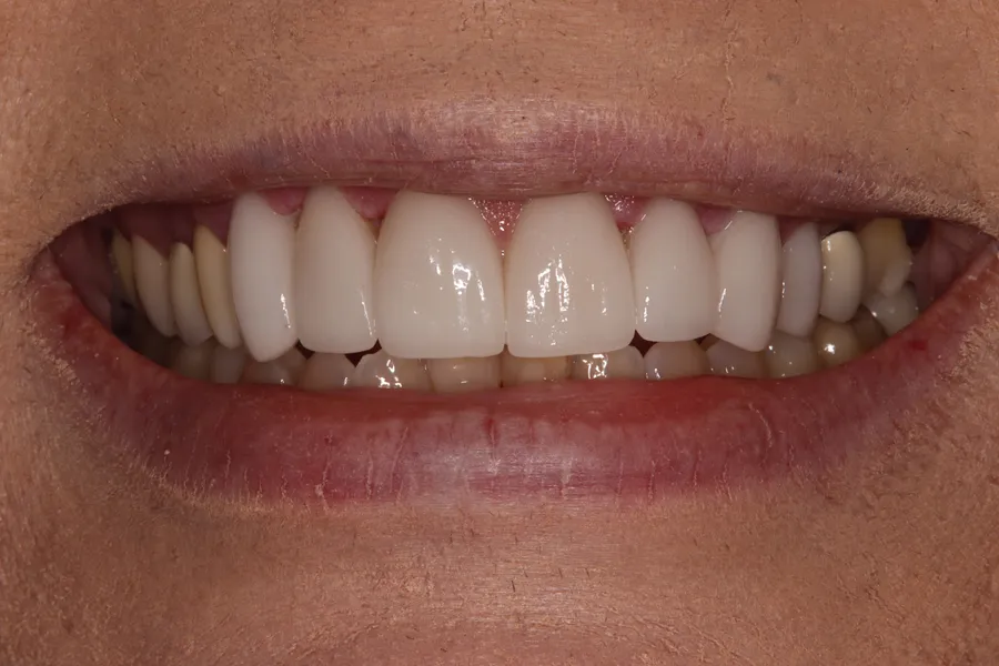 After (close-up), 6 Porcelain Veneers: DJ
