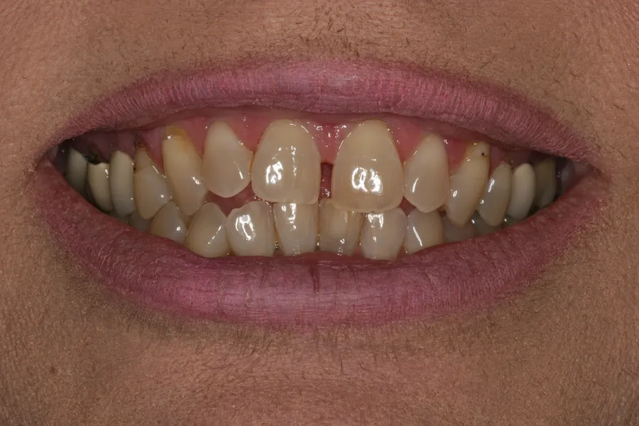 Before (close-up), 6 Porcelain Veneers: DJ