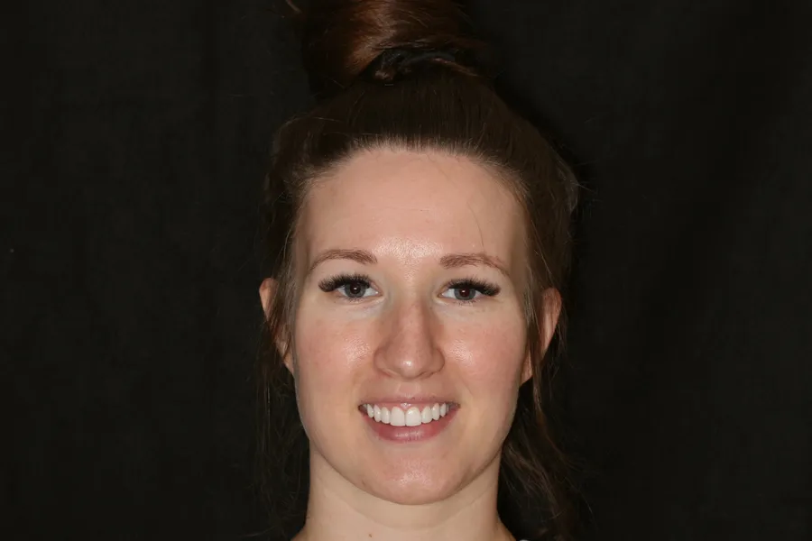After, 8 Porcelain Veneers: Elizabeth
