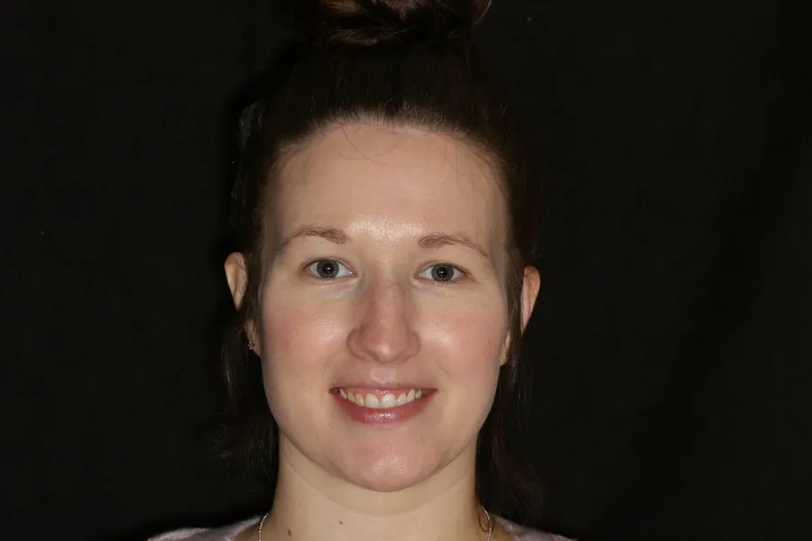 Before, 8 Porcelain Veneers: Elizabeth
