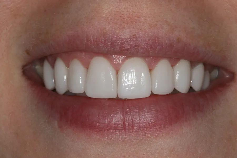After (close-up), 8 Porcelain Veneers: Elizabeth