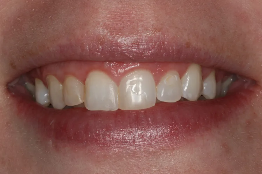Before (close-up), 8 Porcelain Veneers: Elizabeth