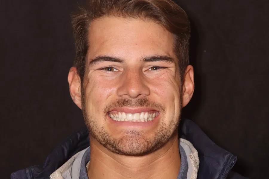 Before, 8 Veneers + 2 Esthetic Crowns: Eric