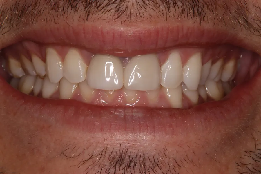 Before (close-up), 8 Veneers + 2 Esthetic Crowns: Eric