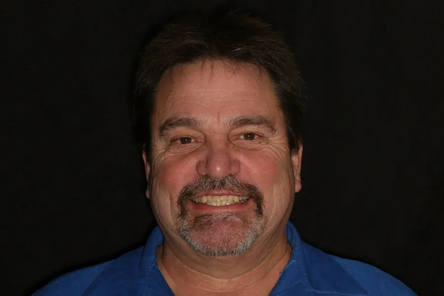 Before, 4 All-Porcelain Crowns: Geoff