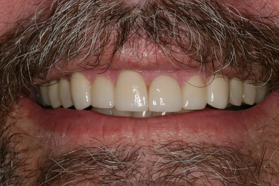 After (close-up), 4 All-Porcelain Crowns: Geoff