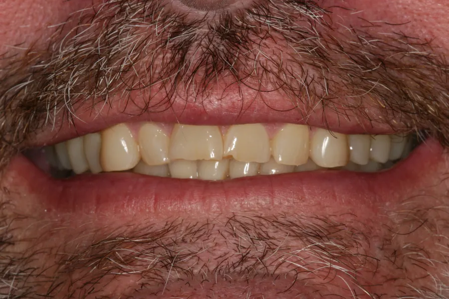 Before (close-up), 4 All-Porcelain Crowns: Geoff