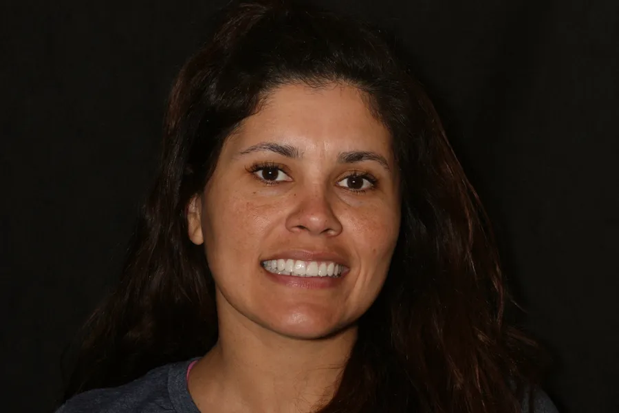 After, 8 Porcelain Veneers: Janelle