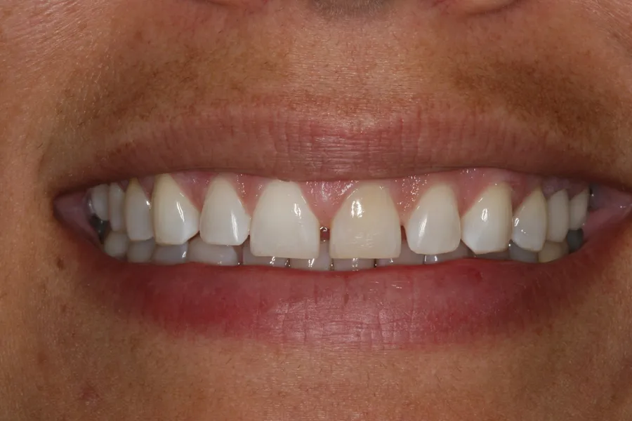 Before (close-up), 8 Porcelain Veneers: Janelle