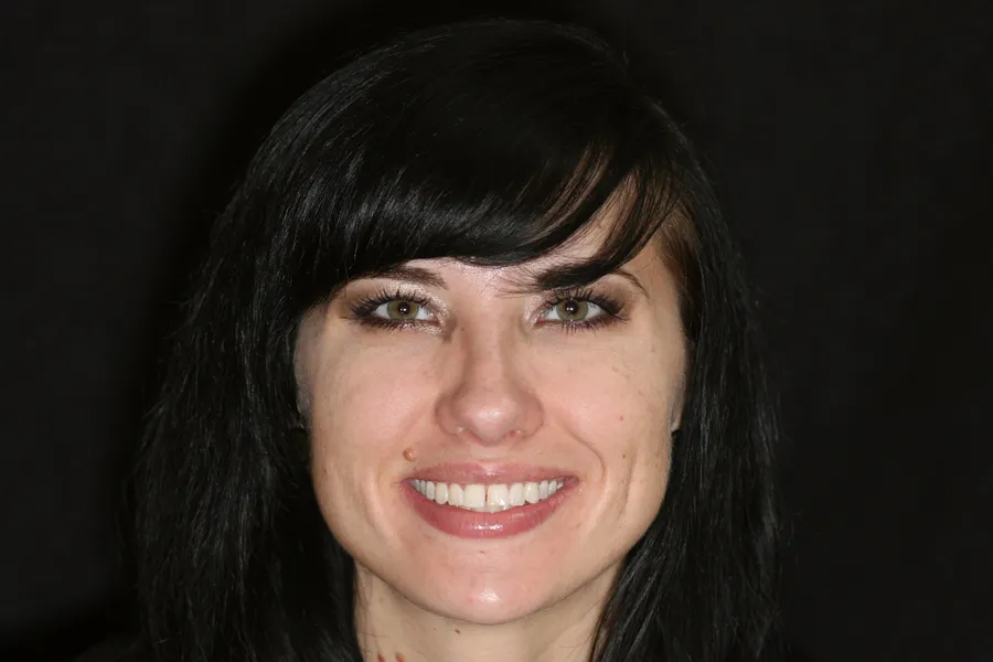 Kristy's smile transformation at Rod Gleave, DMD, before, portrait
