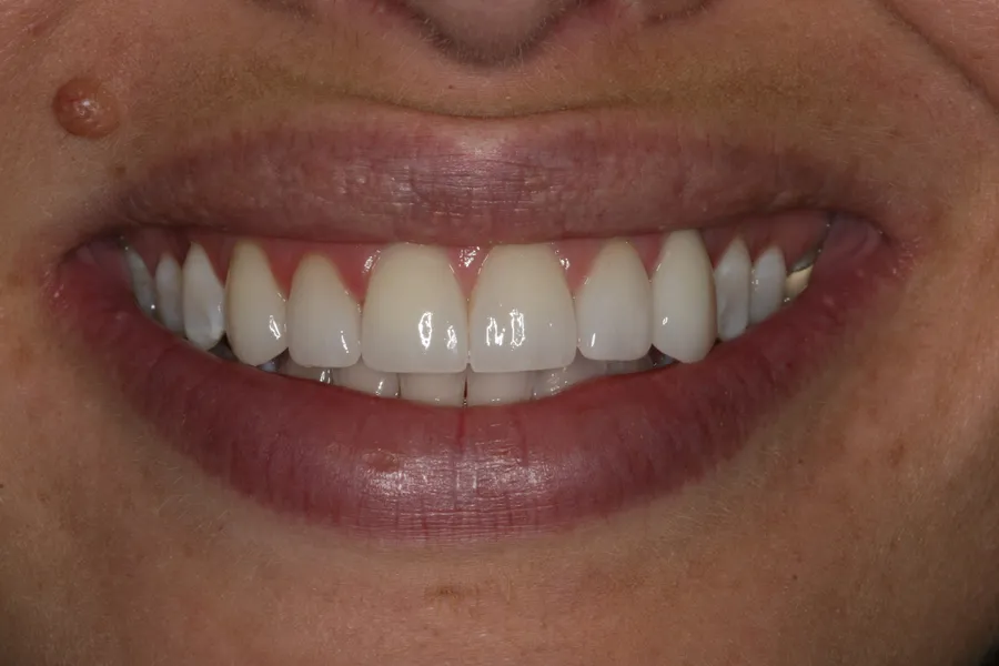 Kristy's smile transformation at Rod Gleave, DMD, after