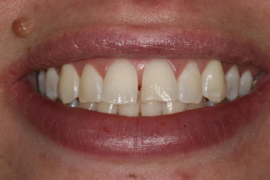 Kristy's smile transformation at Rod Gleave, DMD, before