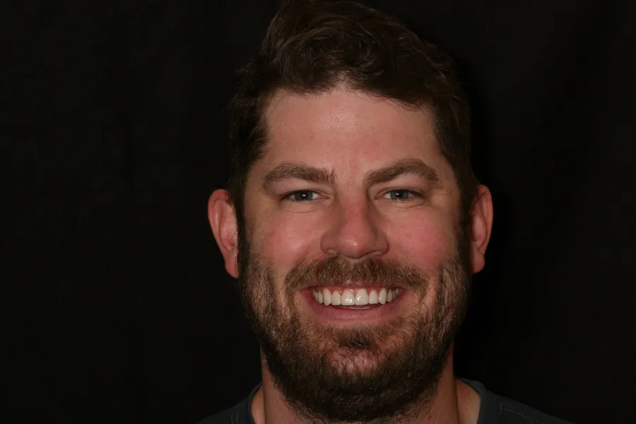 After, 8 Porcelain Veneers: Nate