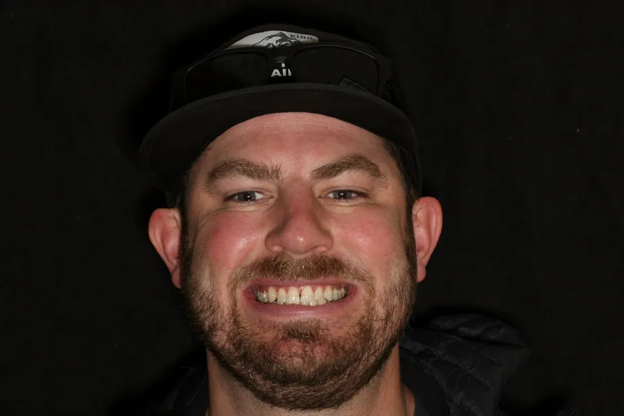 Before, 8 Porcelain Veneers: Nate