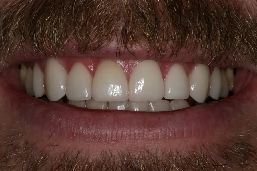 After (close-up), 8 Porcelain Veneers: Nate