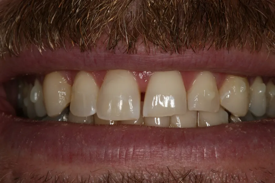Before (close-up), 8 Porcelain Veneers: Nate