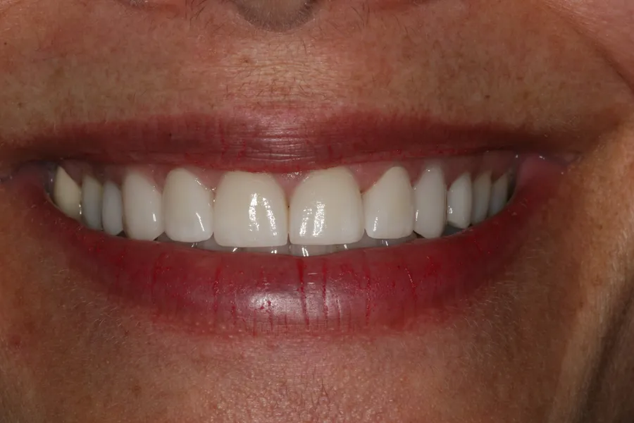 After (close-up), 8 Porcelain Veneers: Pam