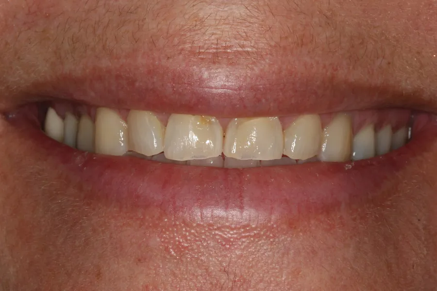 Before (close-up), 8 Porcelain Veneers: Pam