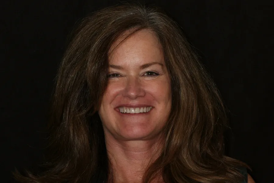 After, 10 Porcelain Veneers: Penny