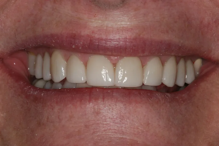 After (close-up), 10 Porcelain Veneers: Penny