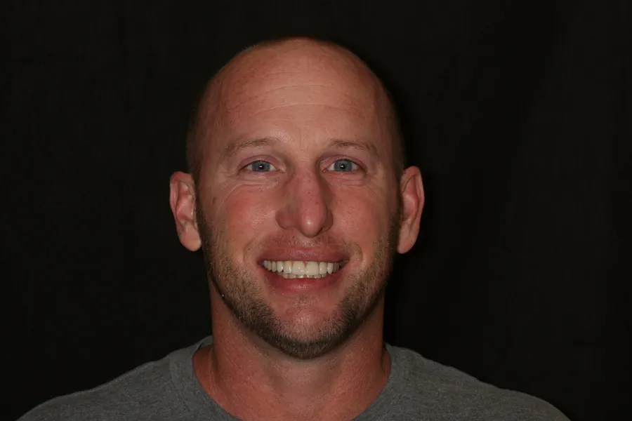 After, 8 Porcelain Veneers: Ray