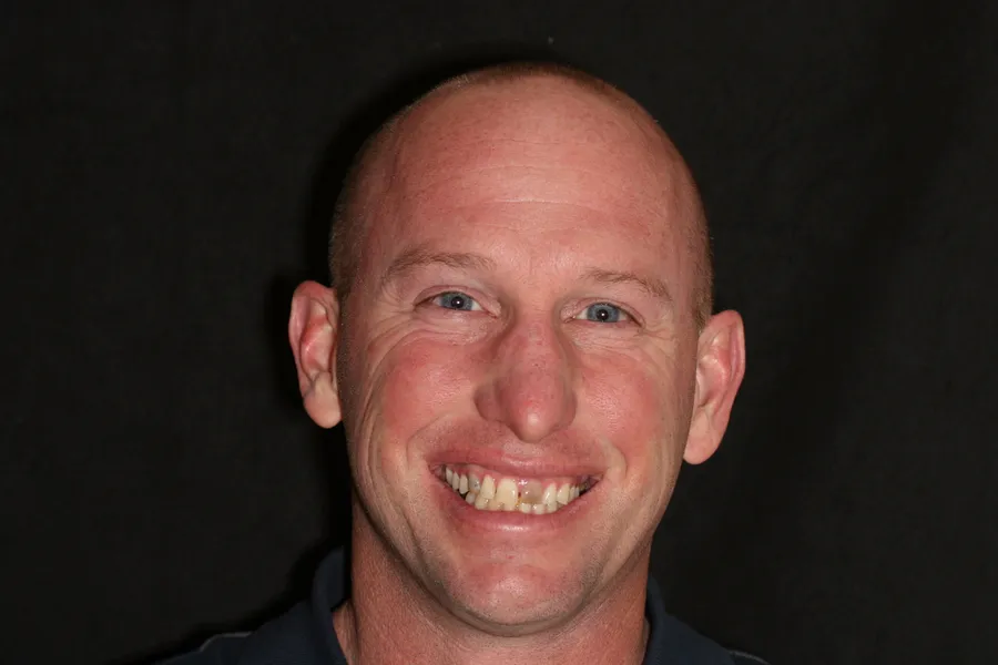 Before, 8 Porcelain Veneers: Ray