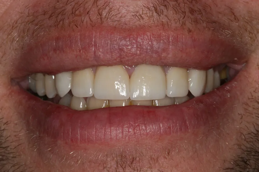 After (close-up), 8 Porcelain Veneers: Ray