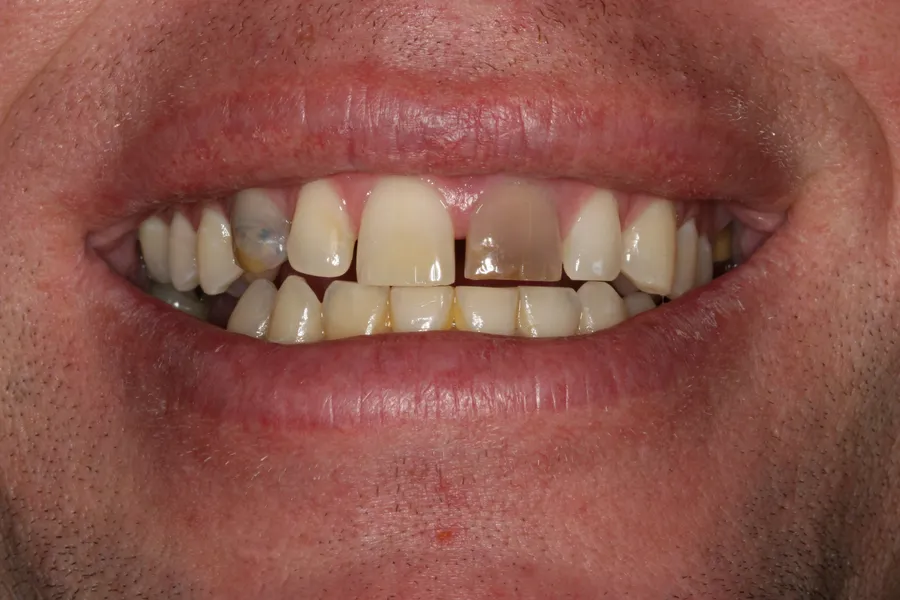 Before (close-up), 8 Porcelain Veneers: Ray