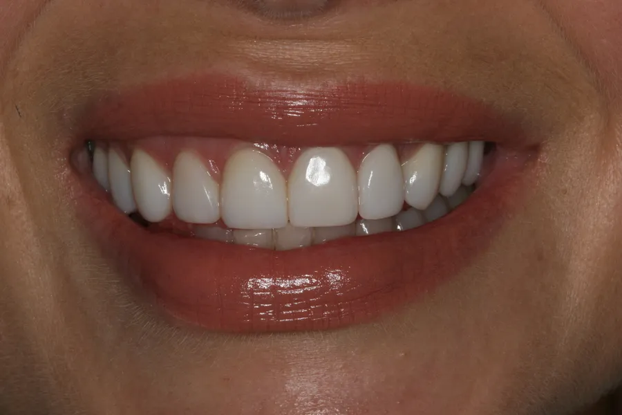 Saria's smile transformation at Rod Gleave, DMD, after