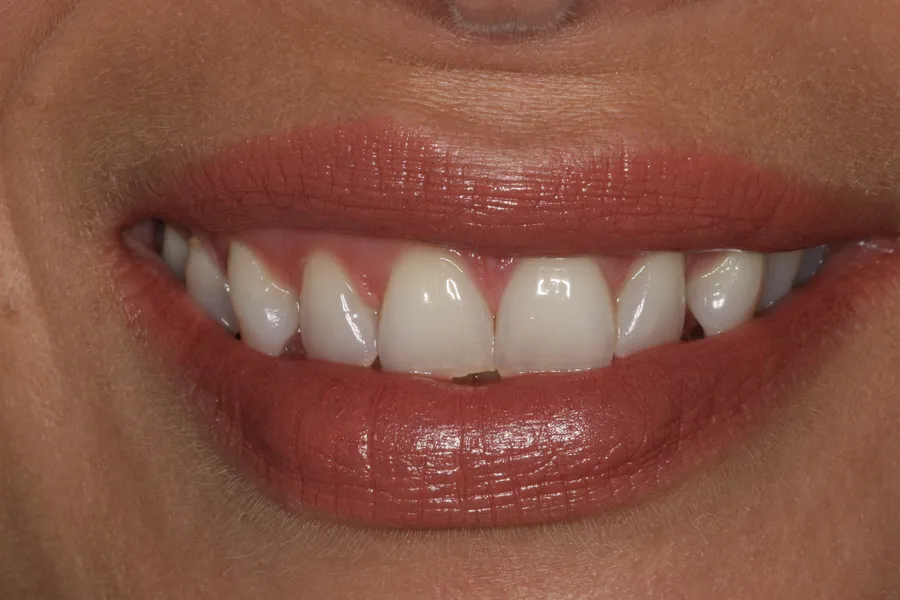 Saria's smile transformation at Rod Gleave, DMD, before