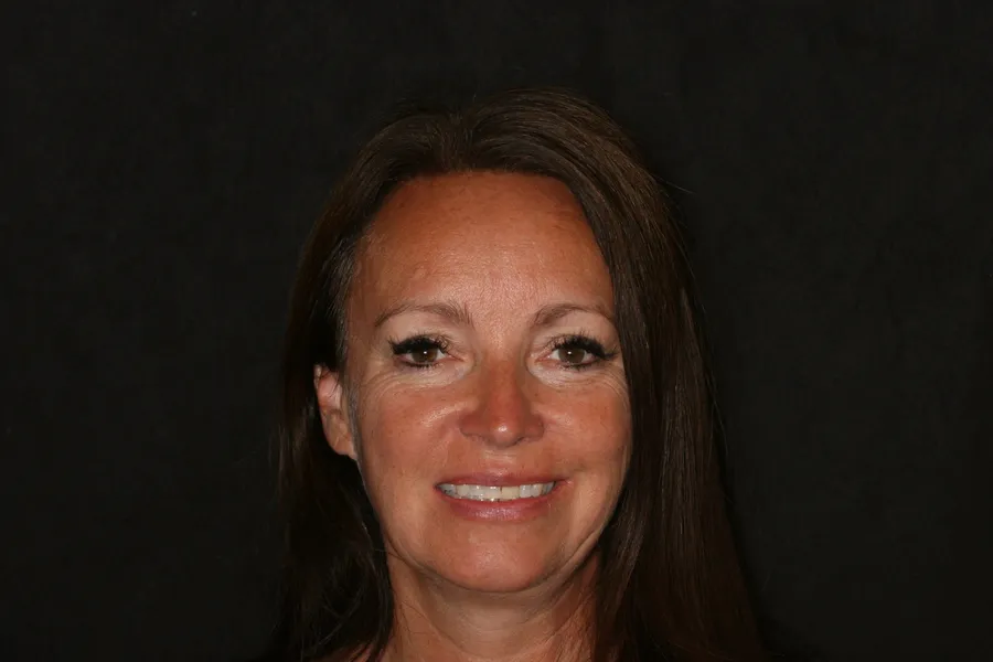 Sharon's smile transformation at Rod Gleave, DMD, before, portrait
