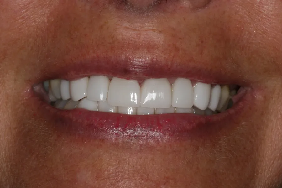 Sharon's smile transformation at Rod Gleave, DMD, after