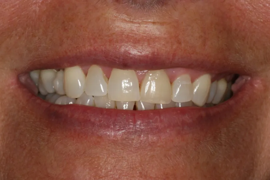 Sharon's smile transformation at Rod Gleave, DMD, before