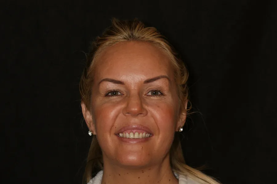 Before, 8 Veneers + Laser Gum Contouring: Tiffin
