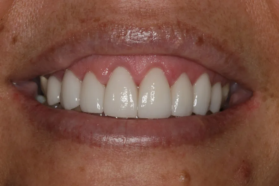After (close-up), 8 Veneers + Laser Gum Contouring: Tiffin