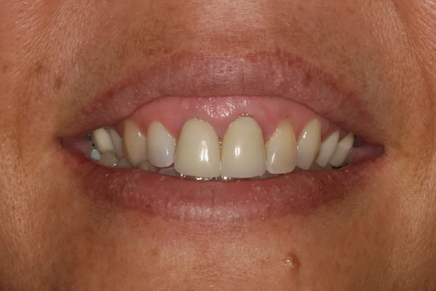 Before (close-up), 8 Veneers + Laser Gum Contouring: Tiffin