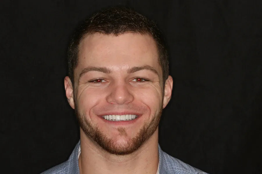 After, 10 Porcelain Veneers: Zach